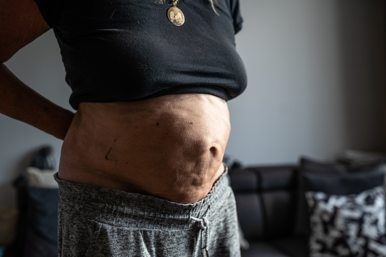 Liposuctie in Turkije eindigt in 'pure horror' voor Audrey: ‘Mijn buik ...